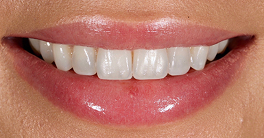 After - Ringway Dental
