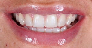 After - Ringway Dental