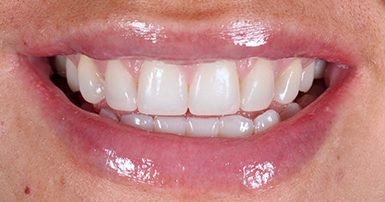 After - Ringway Dental