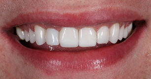 After - Ringway Dental