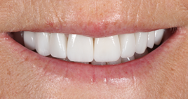 After - Ringway Dental