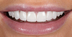 After - Ringway Dental
