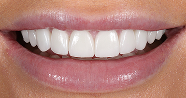 After - Ringway Dental