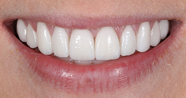 After - Ringway Dental