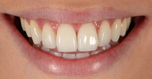 After - Ringway Dental