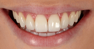 After - Ringway Dental