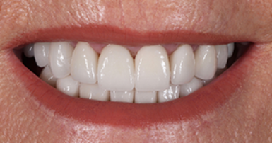 After - Ringway Dental