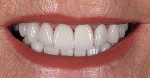 After - Ringway Dental
