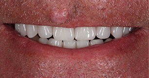 After - Ringway Dental