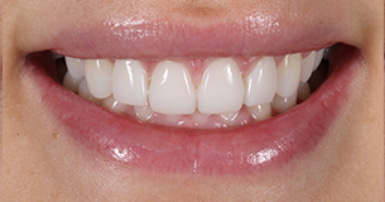 After - Ringway Dental