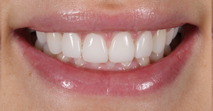 After - Ringway Dental