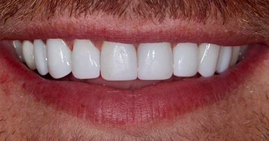 After - Ringway Dental