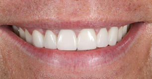 After - Ringway Dental
