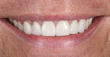 After - Ringway Dental