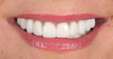 After - Ringway Dental