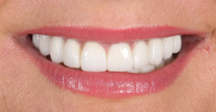 After - Ringway Dental