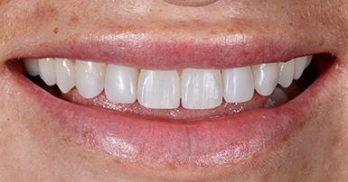 After - Ringway Dental