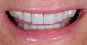 After - Ringway Dental