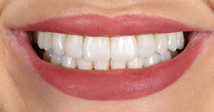 After - Ringway Dental