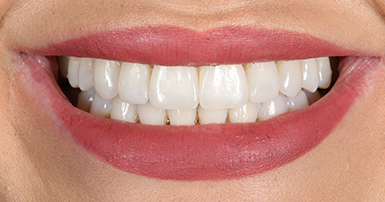 After - Ringway Dental