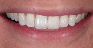 After - Ringway Dental