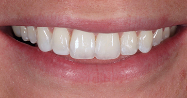 After - Ringway Dental