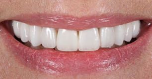After - Ringway Dental