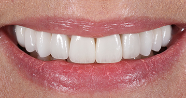 After - Ringway Dental
