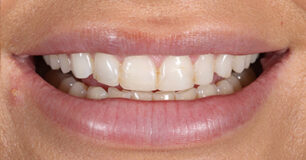Before - Ringway Dental