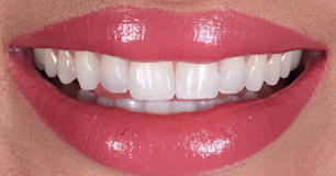 After - Ringway Dental