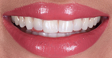 After - Ringway Dental