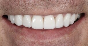 After - Ringway Dental
