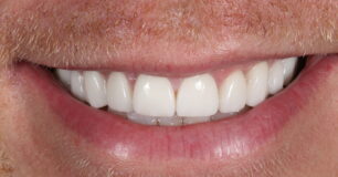 After - Ringway Dental
