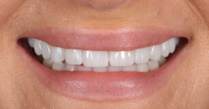 After - Ringway Dental