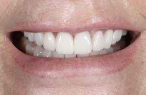 Dental Implants Manchester