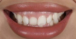 Before - Ringway Dental