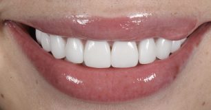 After - Ringway Dental