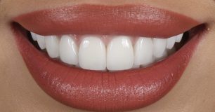 After - Ringway Dental
