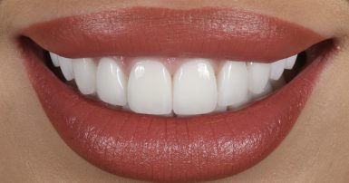 After - Ringway Dental