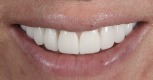 After - Ringway Dental