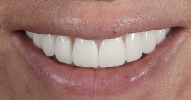 After - Ringway Dental