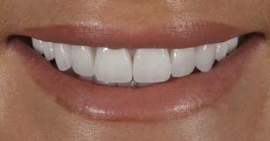 After - Ringway Dental