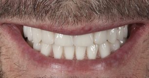 After - Ringway Dental