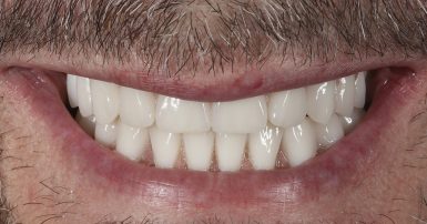 After - Ringway Dental