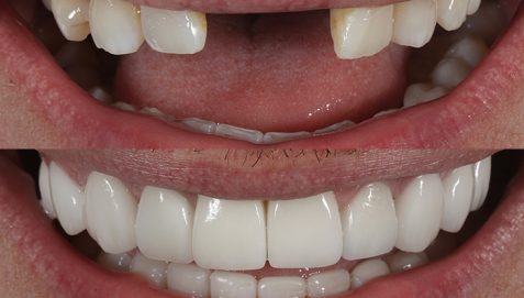 dental-implants-manchester