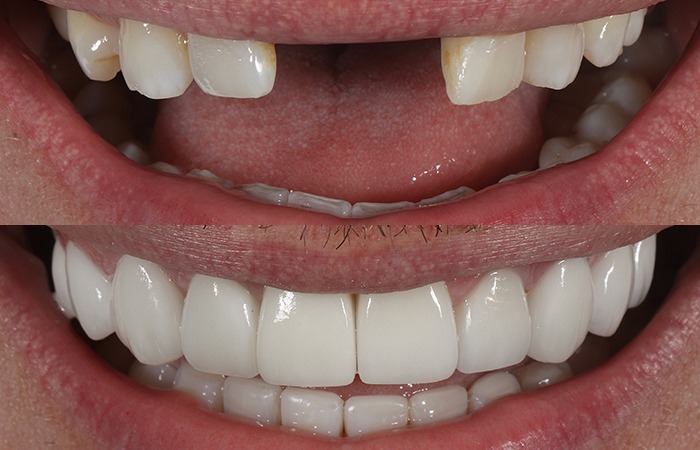 dental-implants-manchester