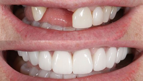 dental-implants-manchester
