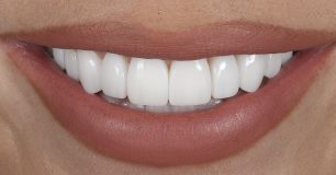 After - Ringway Dental