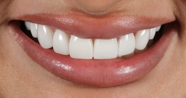 After - Ringway Dental